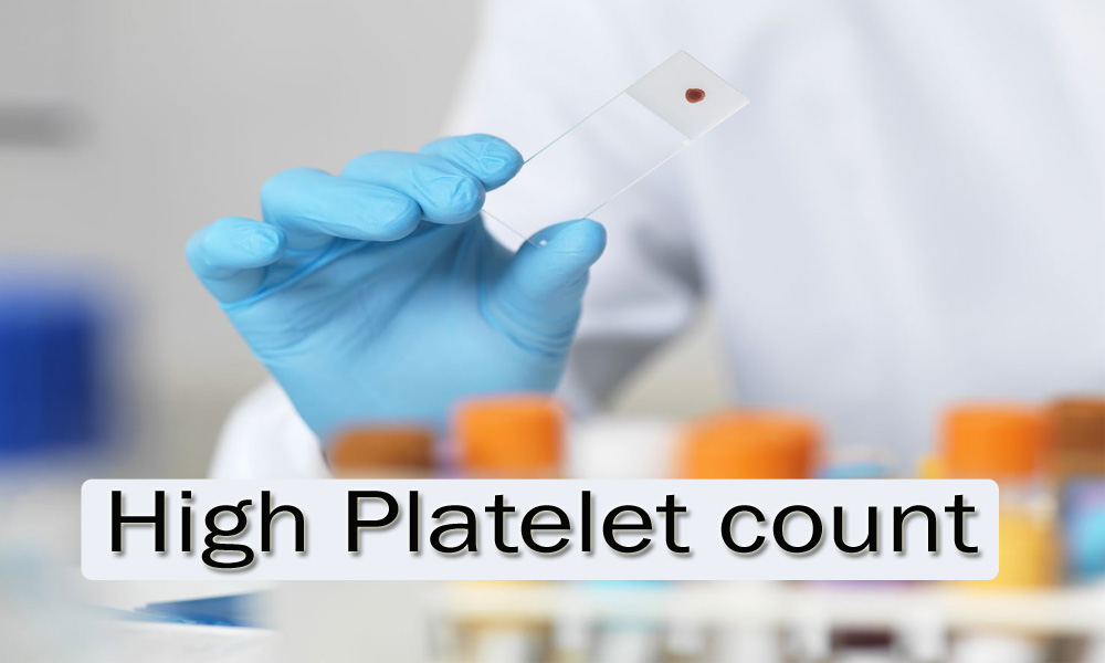 High Platelet count
