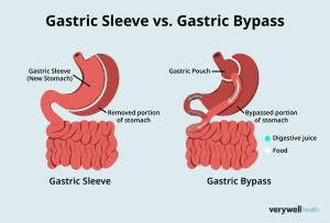Types of Weight-Loss Surgery: Gastric Bypass vs. Sleeve Gastrectomy ...
